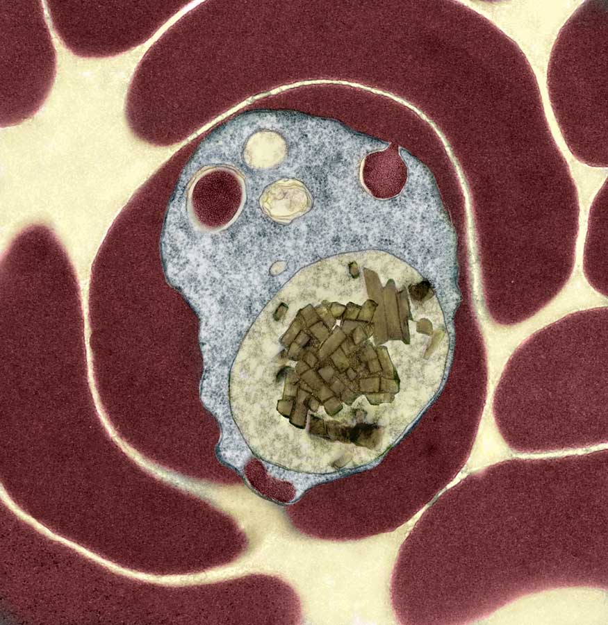 Hemozoin crystals in the food vacuole of the malaria parasite. Color was added using imaging software.