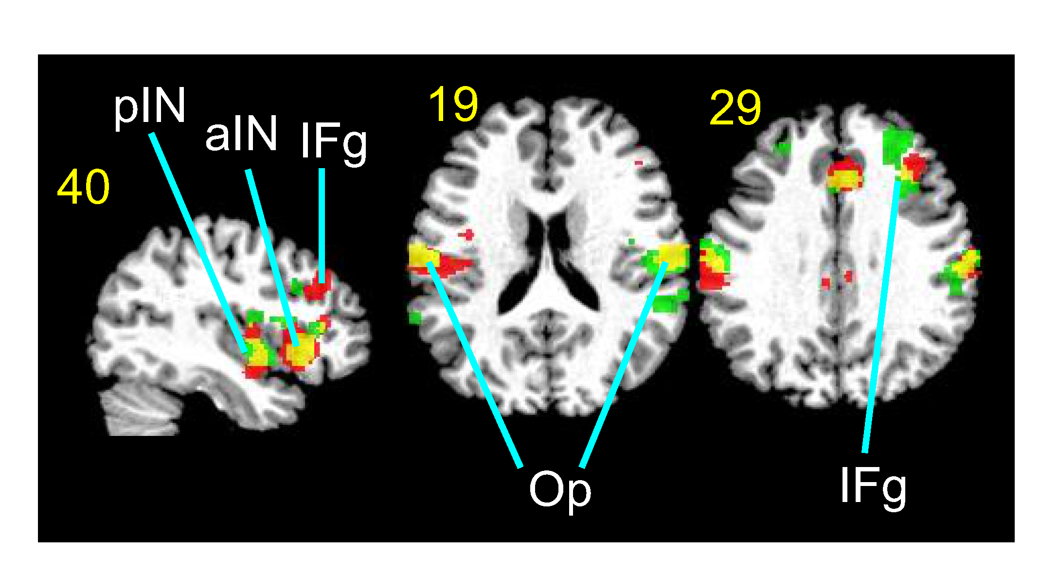 Functional magnetic resonance images of the brain responding to different ultrasound parameters