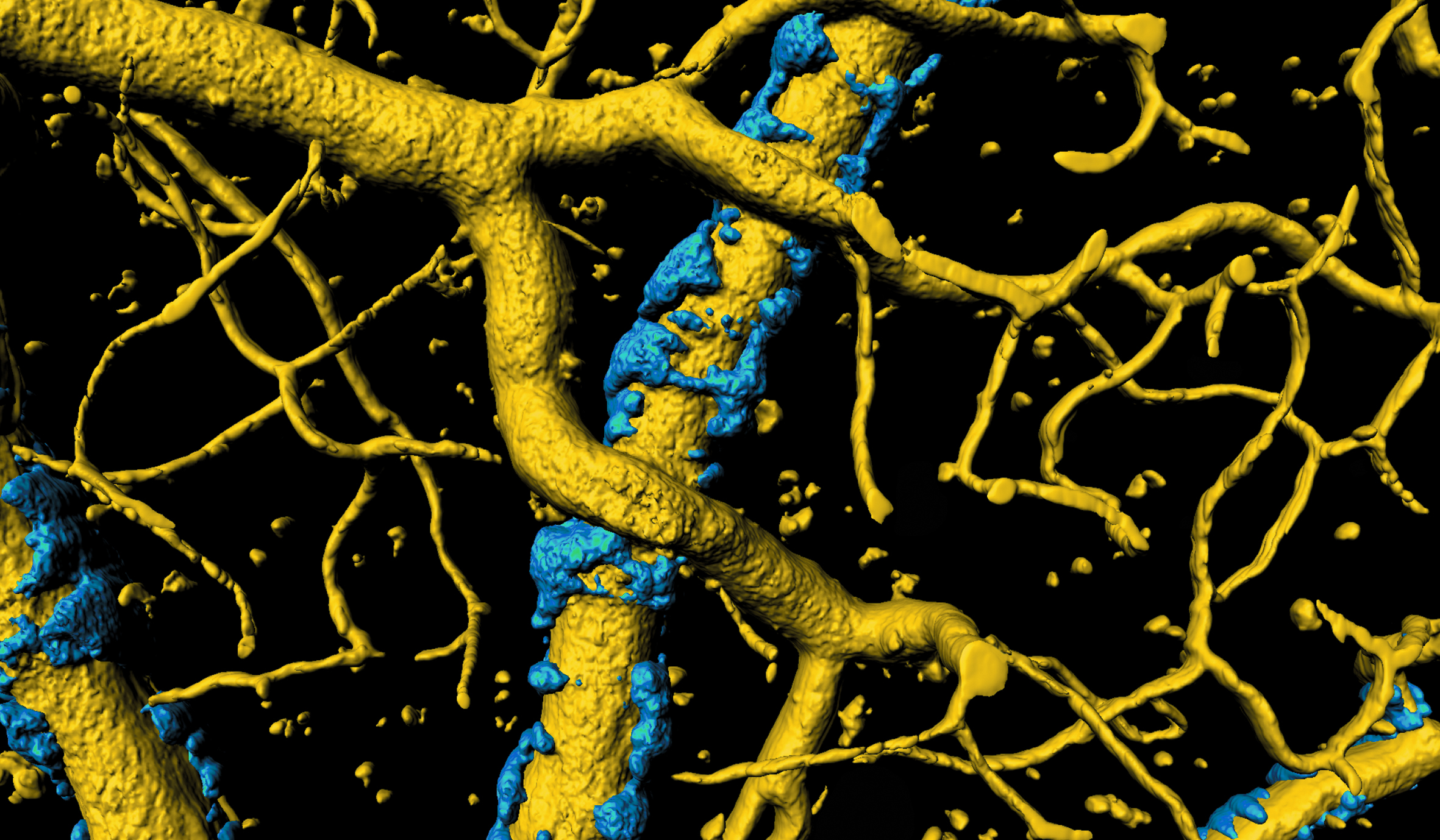 A buildup of misfolded proteins causes an exoskeleton (in blue) to form around blood vessels (in gold) in the brain.